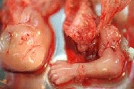 الاجهاض يقود زوجين بسطات إلى تدابير الحراسة النظرية